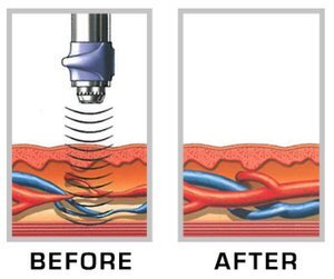 Acoustic Wave Therapy Cost