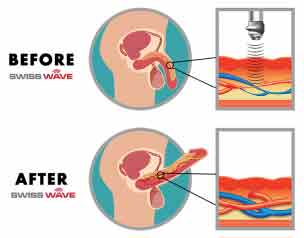 Acoustic Wave Therapy